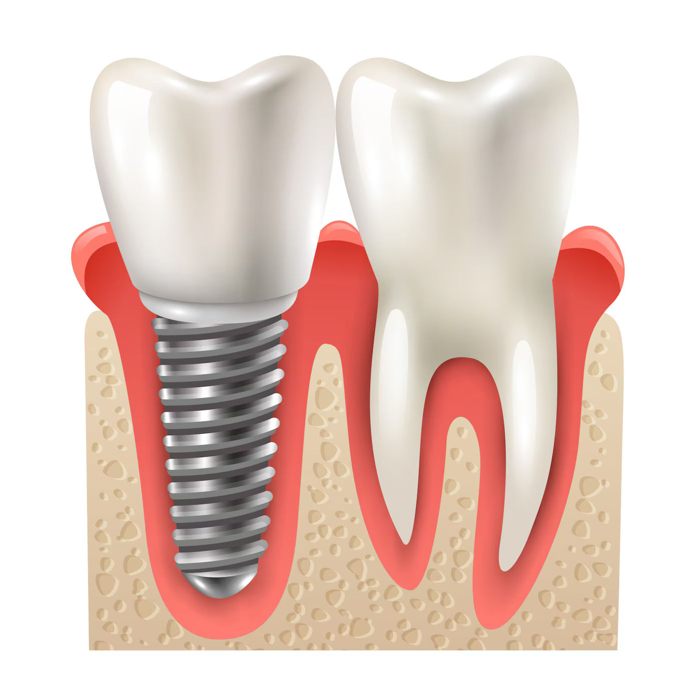 dental solutions tooth deterioration dental wellness dental procedures - The Dome - Dentistry and Implants dental implant benefits functional advantages of implants